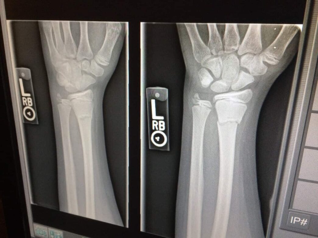 What Accidents Typically Cause A Broken Bones Injury? And How You Can Get Compensation