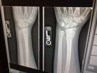 What Accidents Typically Cause A Broken Bones Injury? And How You Can Get Compensation