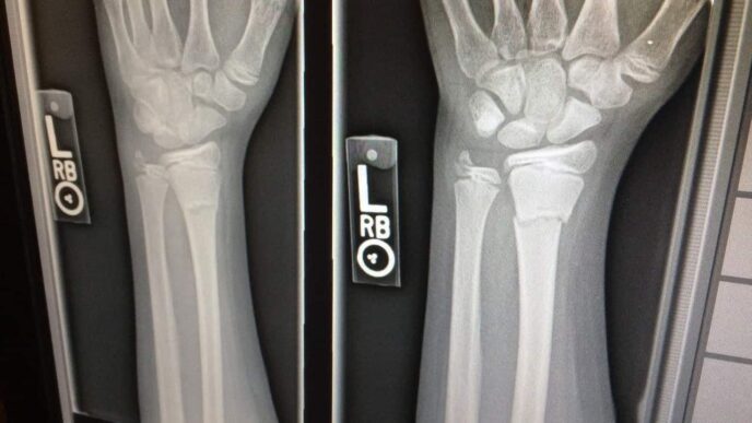What Accidents Typically Cause A Broken Bones Injury? And How You Can Get Compensation
