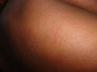 US health secretary reports 2 deaths in Texas measles outbreak