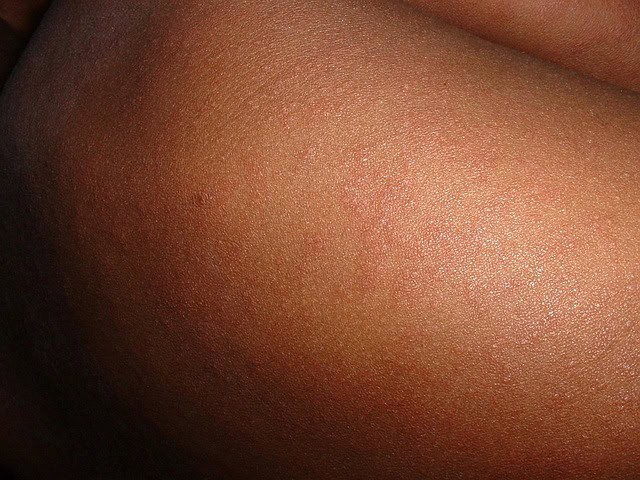 US health secretary reports 2 deaths in Texas measles outbreak